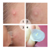 72Pcs Waterproof Salicylic Pimple Patch Blemish Treatment Skin Care Acne Repair for Skin Recover Beautifying - Image 5